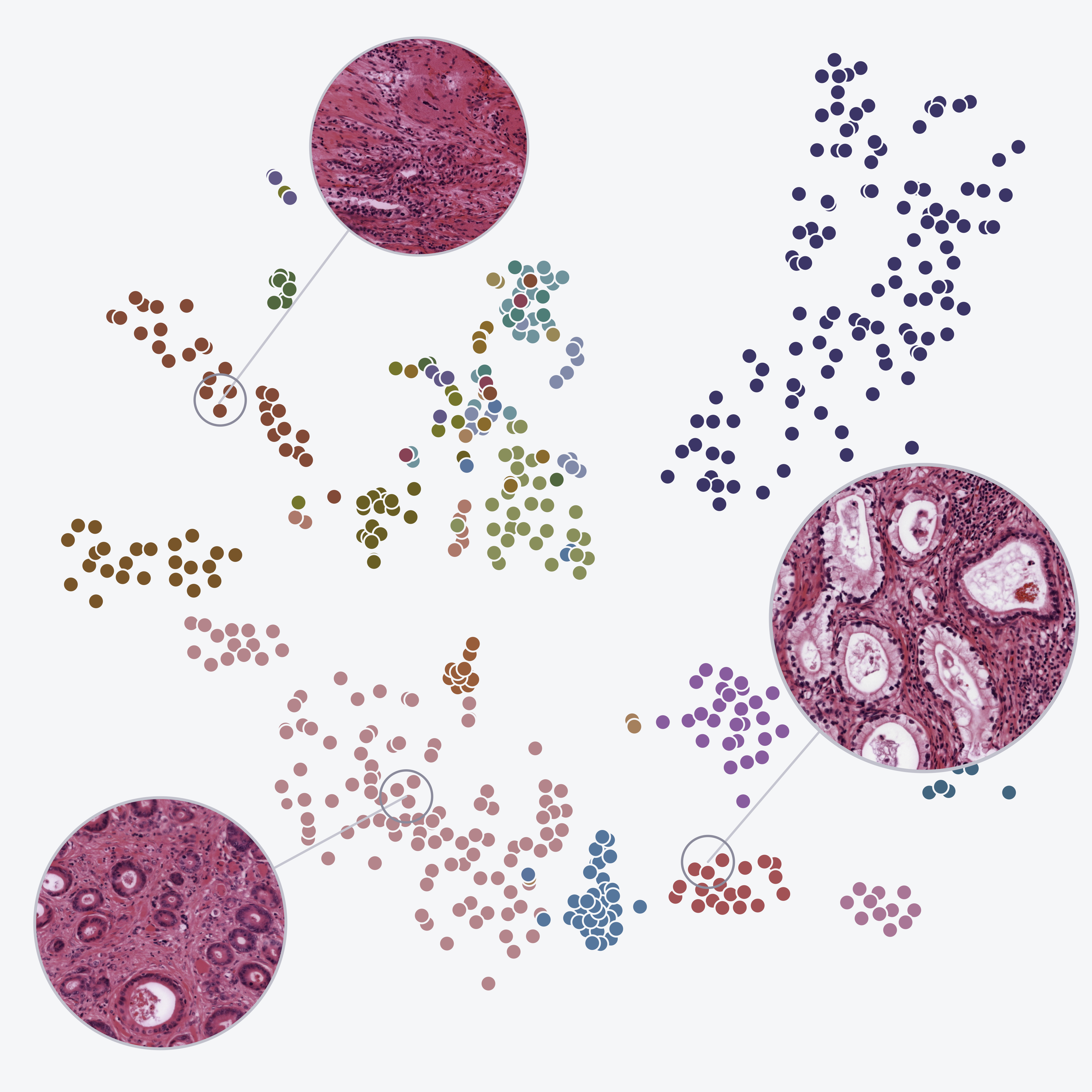 t-SNE projection of genome-wide DNA methylation profiles, with a histology field shown at one cluster
